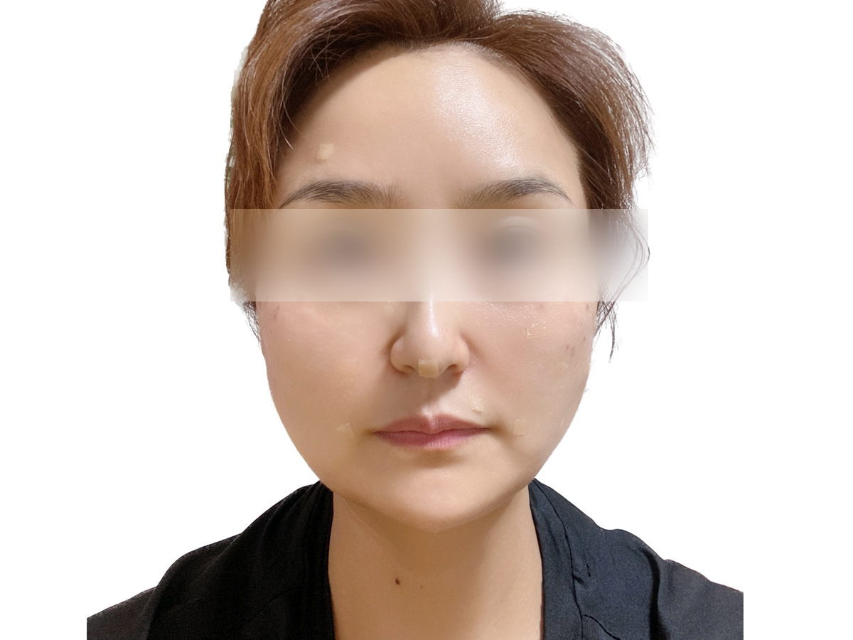 돌기실 시술 후