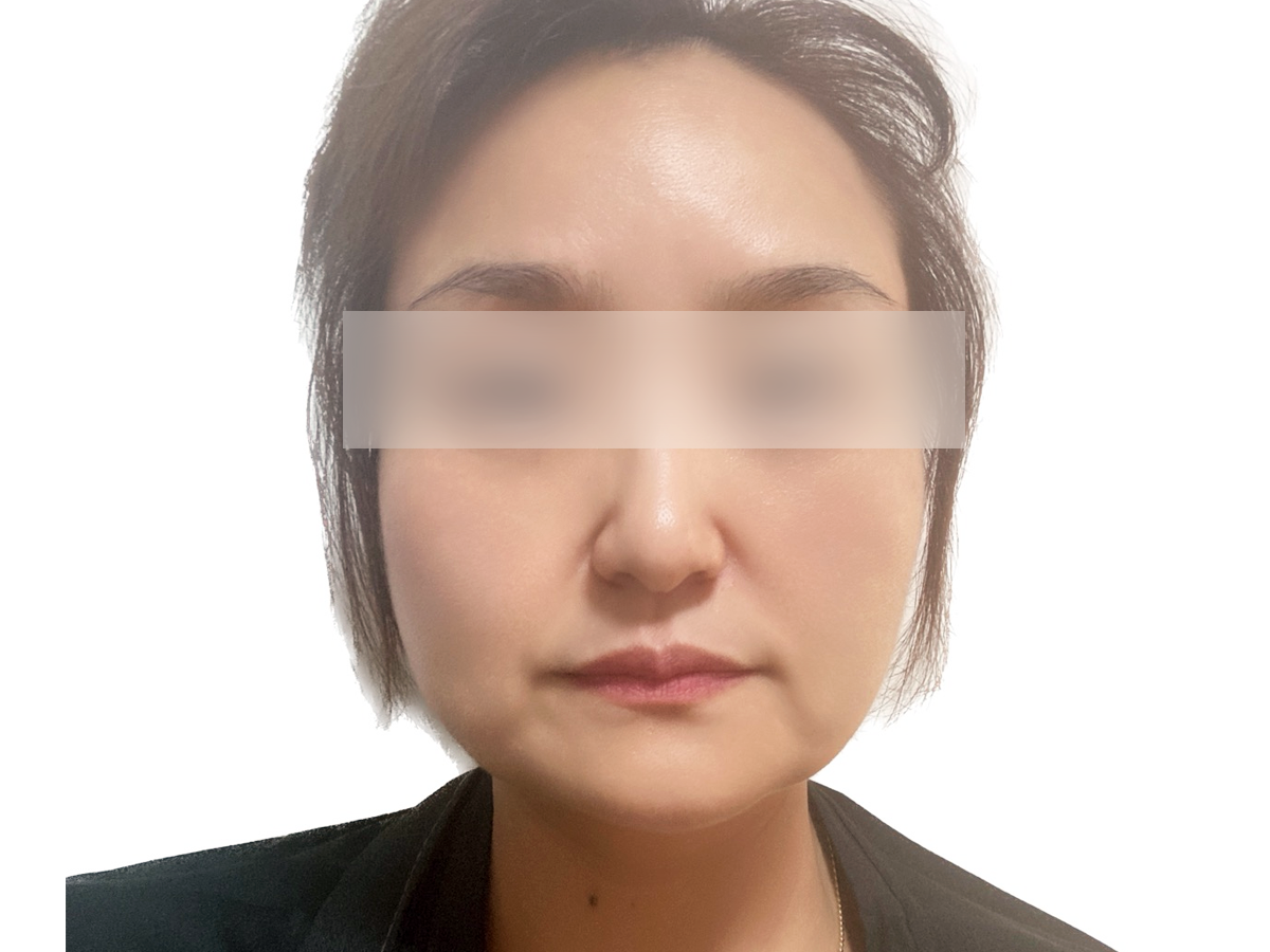 돌기실 시술 전